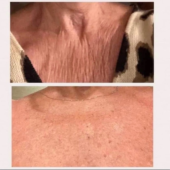 Nu Skin Ageloc Body Soin Minceur Dermatic Effect - 2 Tubes De 150 Ml, Neufs